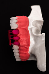Teeth implant and crown installation process parts isolated on a blue background. Medically accurate 3D model. 