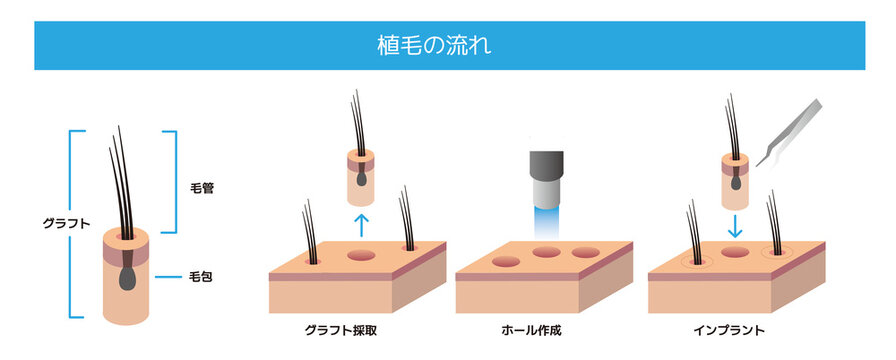 植毛(薄毛AGA)治療の流れの医療イラスト
