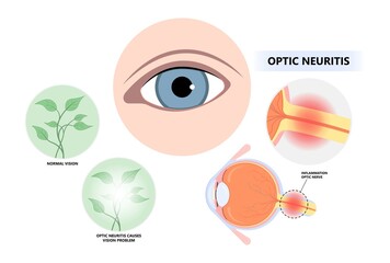Vision loss and visual field eye disc swollen pain retina Demyelination viral Tumor cancer blind with lupus blurring spot light infectious antibody