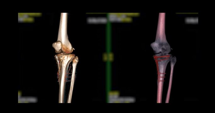 CT Scan of knee joint with fixation  metal on the bone 3d rendering image  turn around on the screen for diagnosis  fracture tibia ,fibula and femur bone.