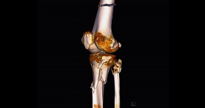 CT Scan of knee joint  3d rendering image  turn around on the screen for diagnosis  fracture tibia ,fibula and femur bone.