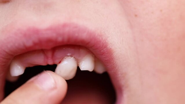 Unrecognizable close up kid mouth, baby gingival milk teeth problem. Touching by finger sagging tooth. Help remove shaking tooth. Changing to permanent. Healthcare and medicine, mouth care and hygiene