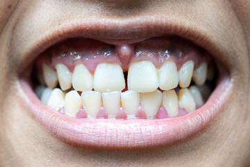 beautiful smile by press ceramic crown and venners
