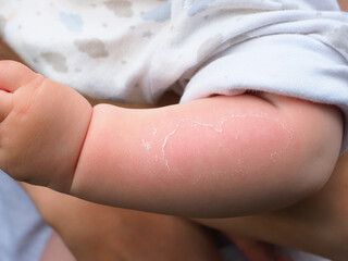 Fototapeta premium sunburn peeling of the skin on the arm of a baby