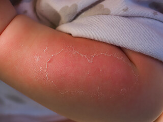 sunburn peeling of the skin on the arm of a baby