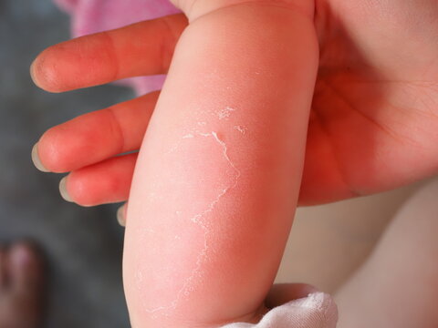 sunburn peeling of the skin on the arm of a baby