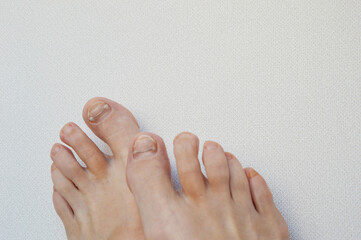 Titanium metal corrector brace mounted on big toe nails. Medical professional pedicure. Podology....