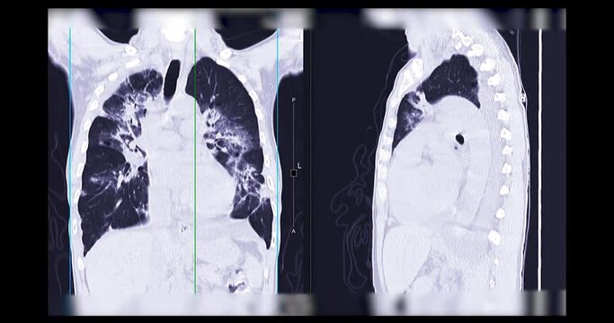 CT Scan of  Chest or Lung for diagnosis lung diseases.