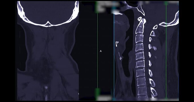 CT SCAN of Cervical Spine ( C-spine ) patient trauma case case   . Medical technology concept.