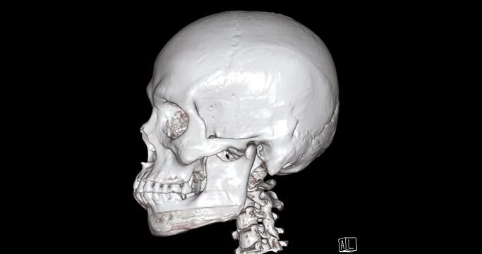 CT Scan of facial bone 3D rendering showng human skull 
 turnaround on the screen .