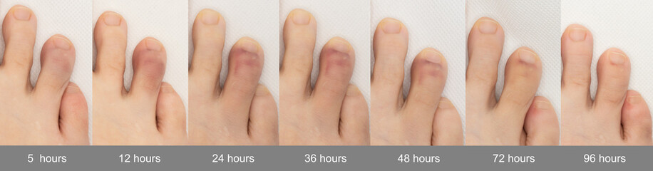 Growth and healing of a bruised toe within four days