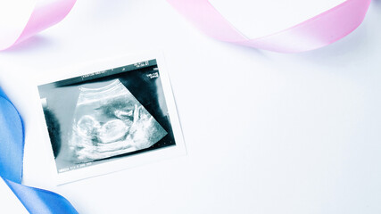 Ultrasound image pregnant baby photo. Blue, pink ribbon with ultrasound pregnancy picture on white background. Concept of pregnancy, maternity, expectation for baby birth.