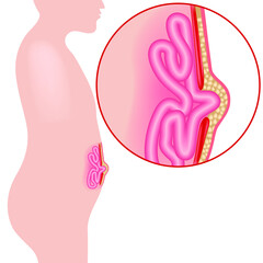 Umbilical hernia. divergence of the abdominal muscles. Internal organs protruding. Medical poster. Vector illustration