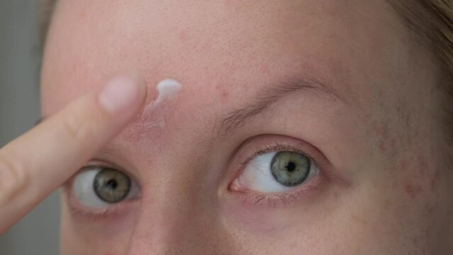 Woman applying cream treatment on acne pimples on the forehead