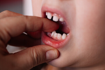 close-up of the roots of the baby tooth sticking out from the gum, the process of changing the baby...