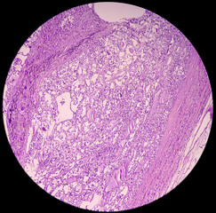 Thyroid gland(biopsy): Nodular goitre and Cystic change, show thyroid follicles ,flattened epithelium and containing colloid material,no malignancy seen.