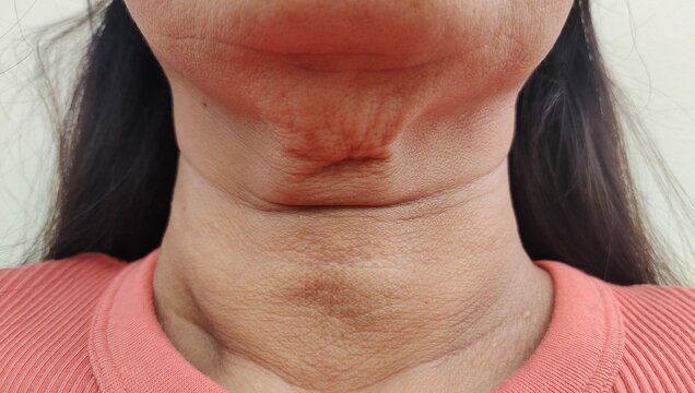 Portrait showing the flabbiness adipose hanging skin under the neck, problem wrinkle and flabby skin under the chin, concept health care.