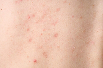 Fototapeta premium Skin with acne, with red spots. Health problem, skin diseases. Close up Allergy rash. Dermatitis problem of rash. 