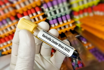 Blood sample tube for Varicella zoster virus or chickenpox test