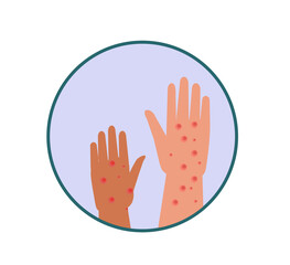 Monkeypox symptoms concept cartoon vector illustration.