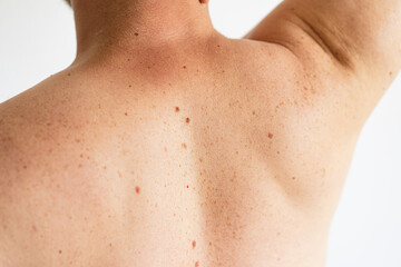 Pigmentation. Close up detail of the bare skin on a man back with scattered moles and freckles. Checking benign moles. Birthmarks on skin
