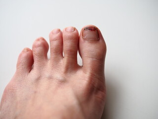 Stepped toenail which is damaged, cracked and bleeding