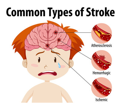 Human with common types of stroke