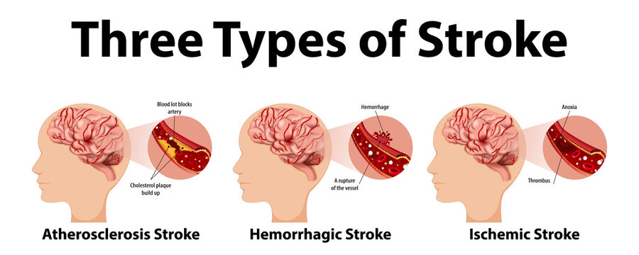 Infographic of common types of stroke