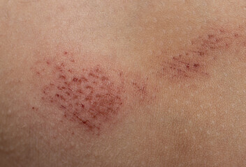 Fototapeta premium scratches on the skin as a background