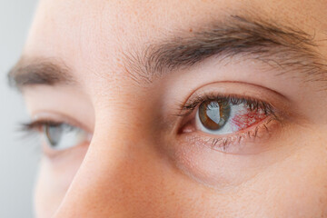 Close-up of male brown eyes with redness and burst vessels. The concept of ophthalmology and...
