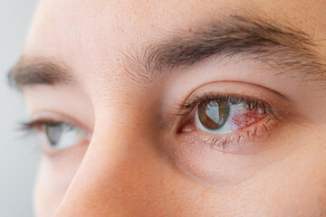 Fototapeta premium Close-up of male brown eyes with redness and burst vessels. The concept of ophthalmology and irritation from lenses