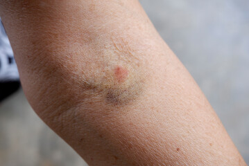 Fototapeta premium Bruising from using a needle to draw blood in the Foldable join