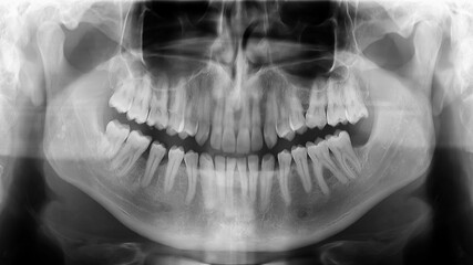 X-ray radiograph picture showing human jaw and teeth - obrazy, fototapety, plakaty