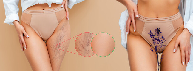 Banner. Slim woman in lingerie and a white shirt poses on a beige background, showing a vascular mesh on her thigh and results after medical procedure. The concept of varicose veins