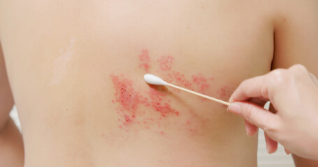 man with shingles disease