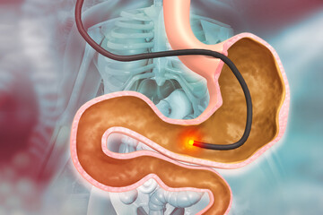 Human Stomach with endoscope and close-up view of bacterium Helicobacter pylori which causes ulcers, stomach ulcer or gastric ulcer, 3d illustration - obrazy, fototapety, plakaty