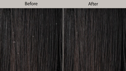 Before and after treatment dandruff and seborrheic dermatitis. Close up of long black hair with hair flakes and healthy hair. Hair care concept. - obrazy, fototapety, plakaty