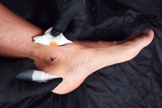 Man's ankle with cut skin and scabby wound treated for sterilization.