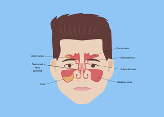 Illustration of man with healthy and inflammed paranasal sinuses on light blue background