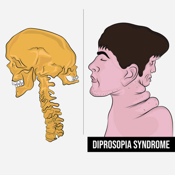 Diprosopus is a rare and life-threatening developmental defect during embryogenesis.