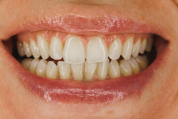Close Up Of A Teeth Smiling Mouth Of A Woman