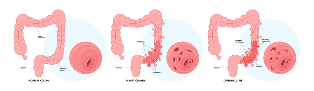 Bowel colon cancer and crohn's disease polyp hernia rectum diverticula ulcer blood stool pain Fecal exam sigmoid diet blocked test C. diff stoma swelling disorder peritonitis rectal