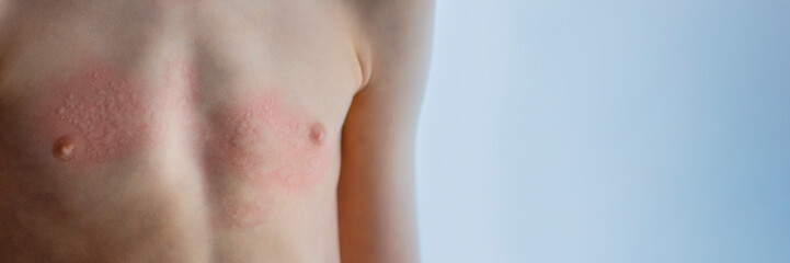 Urticaria on the skin. Red spots of an allergic reaction on the skin of a child. Urticaria symptoms close up