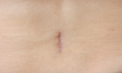 Fototapeta premium close up of careful scar after surgery on the body.
