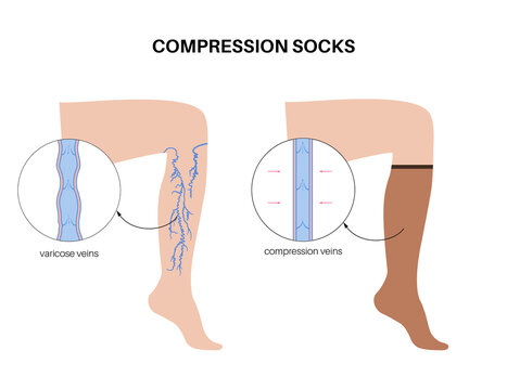 Compression stocking pressure