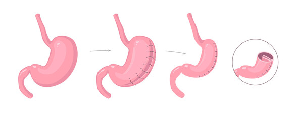 Gastric plication infographics. The explanation picture of stomach reduce method via laparoscopic operation