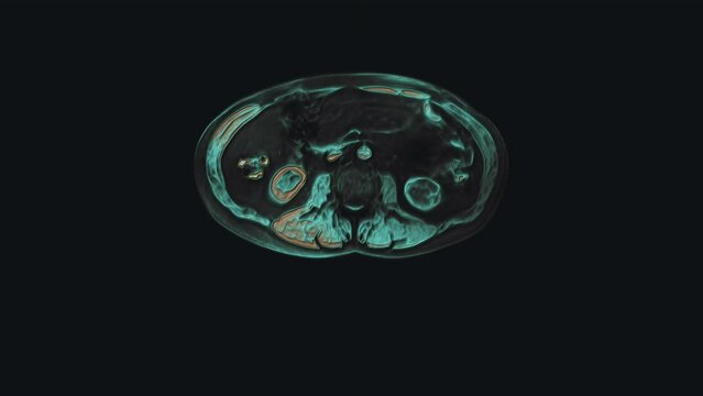 Bulk multicolored CT scan of the abdomen. Computed tomography of the gastrointestinal tract, liver and kidneys