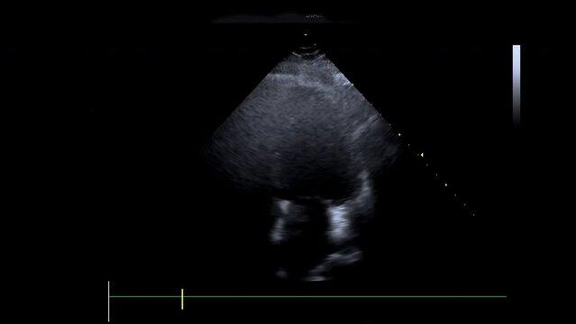 A monitor of the 3d cardiac ultrasound machine with echocardiography view paciente