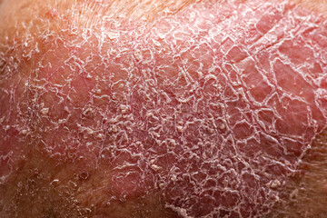 Psoriasis is the abdomen on white background.