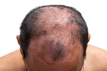 Top Shot, Psoriasis is that head-on white background.